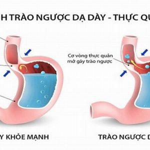 benh trao nguoc da day 300x300 1 1