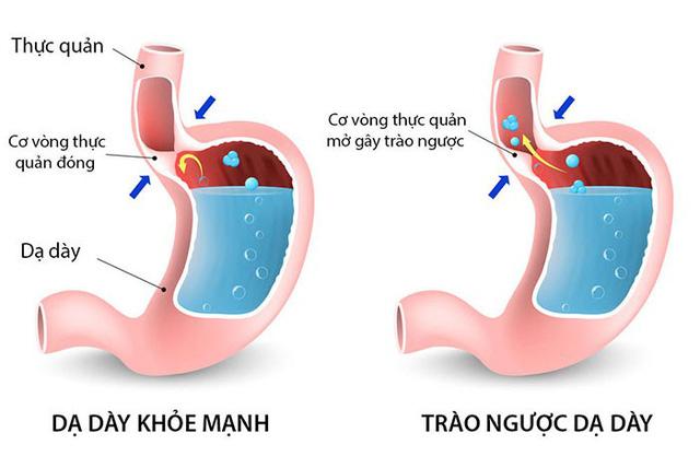 BIẾN CHỨNG NGUY HIỂM DO TRÀO NGƯỢC DẠ DÀY
