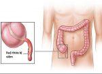 Những điều cần biết về bệnh viêm ruột thừa