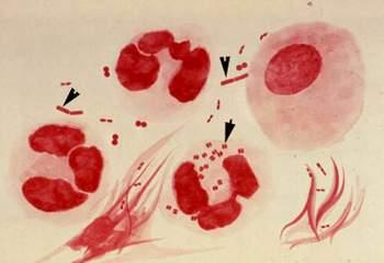 Vi khuẩn song cầu Neisseria gonorrhoeae gây bệnh lậu