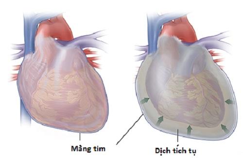 viem-mu-mang-ngoai-tim-nguy-hiem-nhung-co-the-phong-ngua