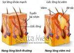 Nguyên nhân, triệu chứng bệnh viêm nang lông