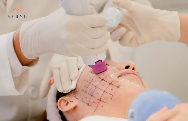 Nguyên tắc xóa nếp nhăn ở gò má tự nhiên, không đơ cứng Cải thiện nếp nhăn má bằng Thermage FLX