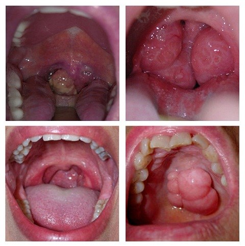 biểu hiện của ung thư vòm họng