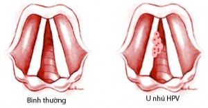 biểu hiện của ung thư vòm họng giai đoạn đầu