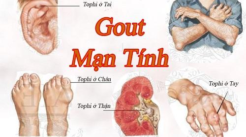 1 benh gout 1