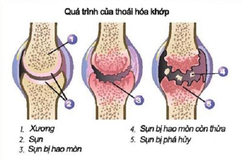 1 benh thoai hoa khop