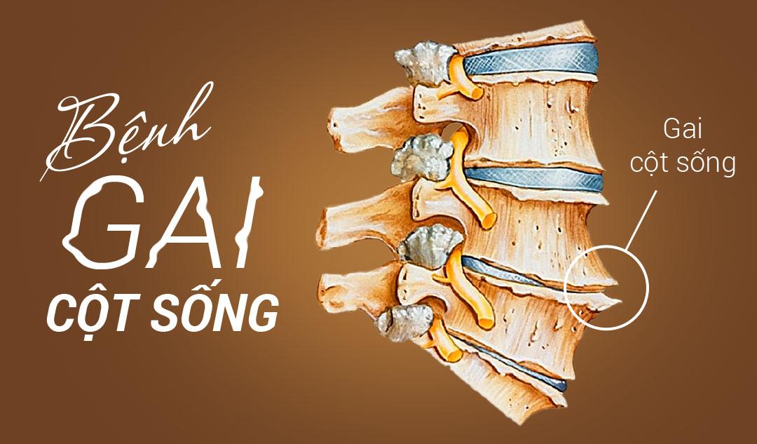 Ngải cứu chữa bệnh gai cột sống như thế nào? - Máy cứu ngải Khánh Thiện,  Công ty Khánh Thiện, Chữa Bệnh đông y