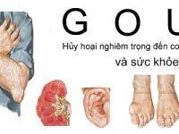 benh gout 200x150 1