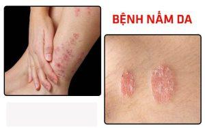 benh nam da la gi