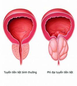 benh phi dai tien liet tuyen co nguy hiem khong 909x1024 2