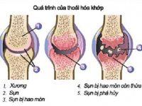 benh thoai hoa khop 200x150 1