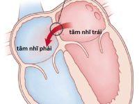 benh tim bam sinh 3 200x150 1