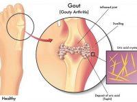 cach dieu tri benh Gout 2 200x150 1