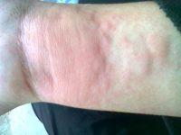 chua tri benh noi me day man ngua 200x150 1