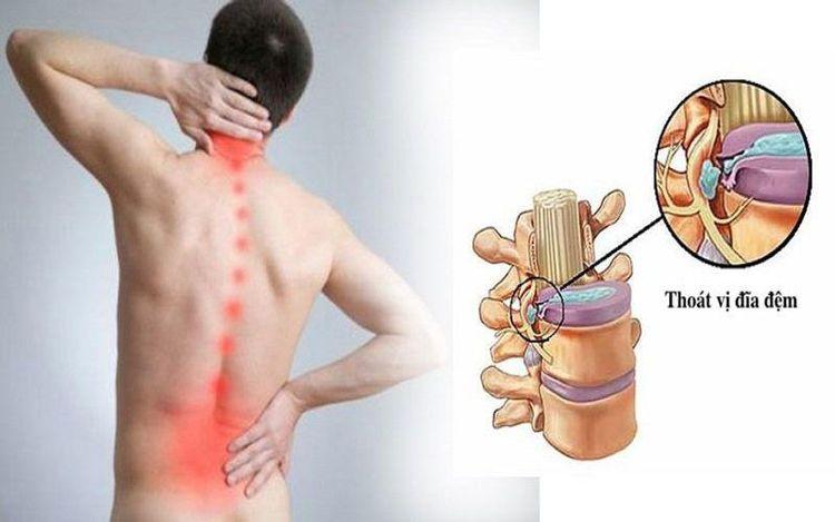 Đánh giá đau cột sống cổ & cột sống thắt lưng | Vinmec