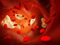 nong do cholesterol trong mau va benh tim mach 1 200x150 1