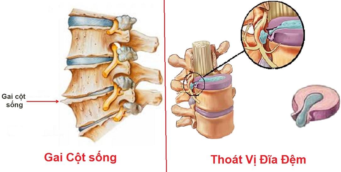 Phân biệt gai cột sống và thoát vị đĩa đệm