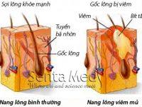viem nang long 200x150 1