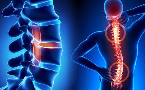 Vôi hóa cột sống: Nguyên nhân, triệu chứng, cách điều trị và phòng bệnh